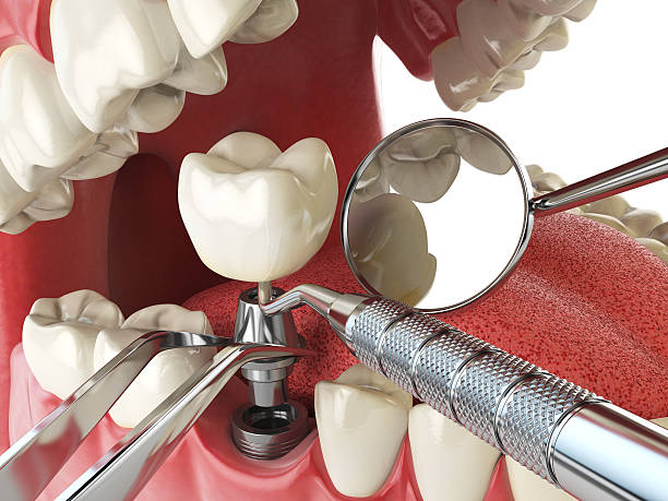 Best Emergency Tooth Extraction in Pickens, SC